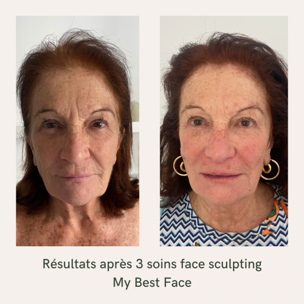 avant après face sculpting visage rajeuni